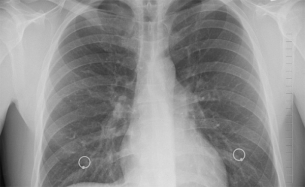 Olomoučtí plicní lékaři odhalili v kraji 5 nemocných 